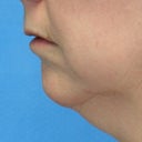 Female Chin Implant 