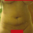 Front, Two Weeks Post Op