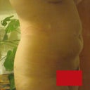 Side, Two Weeks Post Op