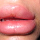 ouchhhh- 21 hours post treatment