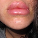 ouch- 21 hours post treatment