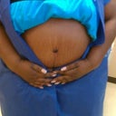 1 WEEK AFTER SURGERY