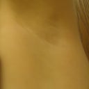 3 weeks after first treatment, 1 week after shaving.