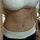 3 weeks after surgery