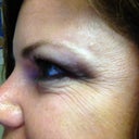 Crows feet, an hour after I was injected with botox.