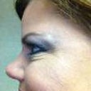 Crows feet today, day 4.
