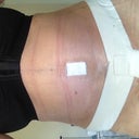 3 days post op - morning