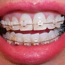 6wk: Teeth are a mess.  Spacing between front teeth, and others. Heard this is necessary for future movement. Yep that's food in my teeth. Ha.  That's what happens if you don't waterpik.
