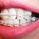 6wk: Teeth are a mess.  Heavy spacing especially on the L teeth. Heard this is necessary for future movement.