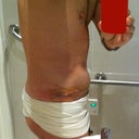 Post Op - Day 1 - Very swollen, but no more bumpy tum!