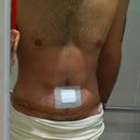 Post Op - Day 1 - Hunched over and swollen! But very happy with the results so far.