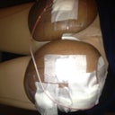 The day of surgery ... So swollen.