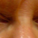 Eyes before injection of Belotero