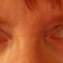 Eyes 30 minutes AFTER Belotero