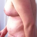 15 days post op - Side view