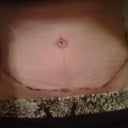 3 weeks post surgery