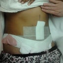 Day 1 Post Op picture