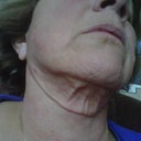 Lower facelift skin fold and now puckering skin above it.  8 months post-op.