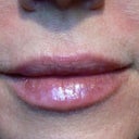 Lips & NL immediately after