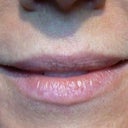 Lips & NL Before
