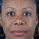 35 Year-Old-Woman Desires A Thinner Nose
