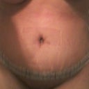 This morning better view of how me scar and belly looks. Day 12