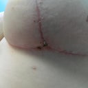 Scabbing
