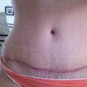 incision at 4 months po