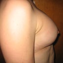 22 days post-op