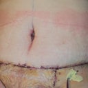 4 days post up. Loads of swelling but no flapping apron of skin! The pink on my tummy is from my compression garment. I need to start wearing something underneath it.