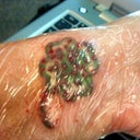1 hour post 1st treatment. There is clear bandage on my tattoo, so it does effect the look of my skin.