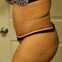 19 days post opt! You can really see the swelling in this pic but it is 100 times better than it was last week!