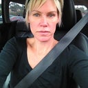before sculptra , thinning of my face,,,