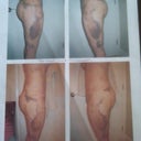 One week post from full lipo after only 1 visit  with Pam!