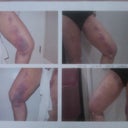 Picture on left one week post lipo- picture on right after one visit- swelling+ busing went down