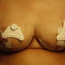 2 days post op. The Triangles are Actipatches, the make such a difference.