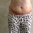 8 days post op