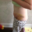 8 days post op