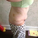 8 days post op
