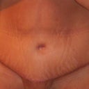 See how all the swelling is low like under the scar and in my pubic area, it is terrible it is really pushing on the incision now