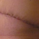 I think the incision looks good still a little glue at spots but I think that is looking OK?