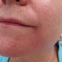66 Year Old Female Treated With Radiesse For Marionette Lines