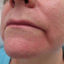 66 Year Old Female Treated With Radiesse For Marionette Lines