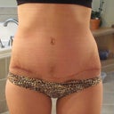 5 1/2 weeks post-op (38 days)- Scar is healing nicely, though quite a bit darker on the left hip (in photo it looks like right hip since photo was taken in mirror). Skin puckering has flattened out almost completely.