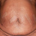 post op day 3 front