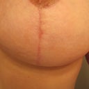 aerola scar