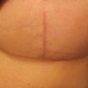 breast scar
