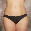 2 Week Post Surger - Flanks (front view)
