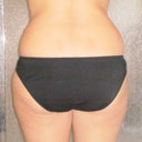 2 Week Post Surgery - Flanks (back view)