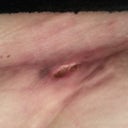 Open sore on scar